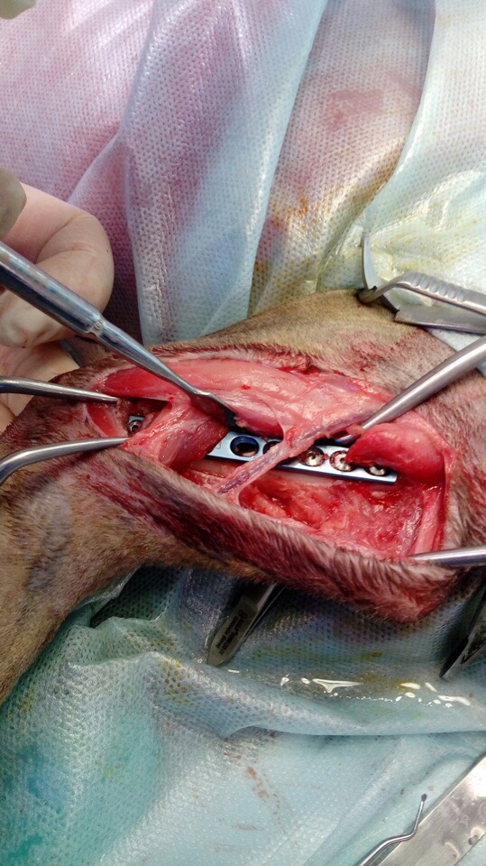 Вид операционной раны после репозиции отломков и окончательной фиксации фрагментов. 