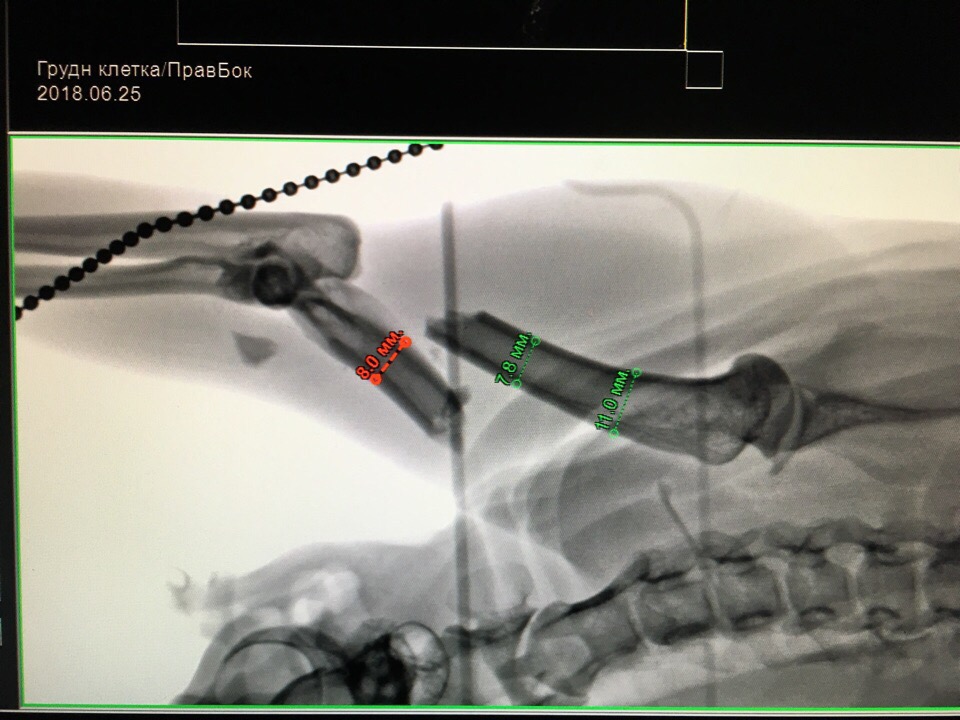 Рентгенография: оскольчатый перелом дистальной половины диафиза плечевой кости правой грудной конечности.