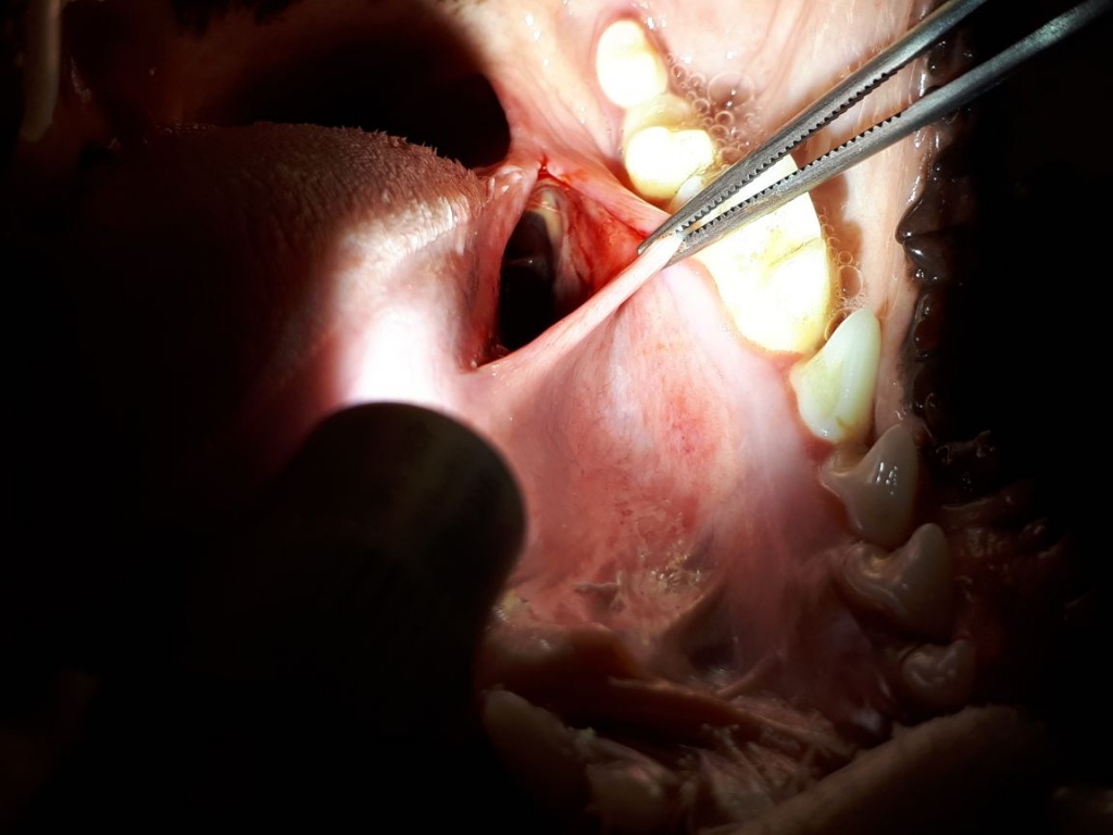 Рана боковой поверхности корня языка до и после хирургической обработки, соответственно